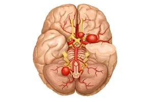 A cerebrovaszkuláris vasospasmus (agyi) tünetek, kezelés, megelőzés