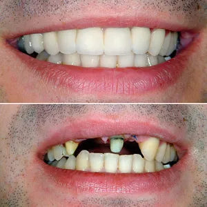 Options protézis felső elülső, alsó fogak, ár, nézetek, vélemények, fotók (árak) Options protézis felső elülső, alsó fogak, ár, nézetek, vélemények, fotók