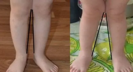 Valgus deformitás láb gyermekeknél fotó patológia