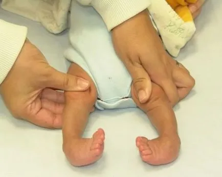 Valgus deformitás láb gyermekeknél fotó patológia