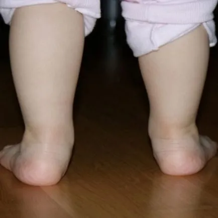 Valgus deformitás láb gyermekeknél fotó patológia