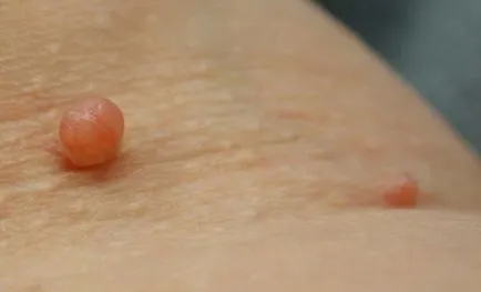 Hogyan lehet eltávolítani a papilloma otthon Szemölcsdaganatok otthon (feltételek) Hogyan lehet eltávolítani a papilloma az otthoni, szemölcsök eltávolítására otthon