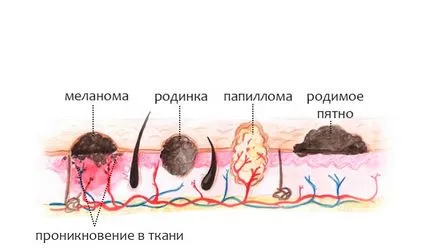 Mivel otthon eltávolítani papilloma gyógyszertár és népi jogorvoslati Mivel otthon eltávolítani papilloma gyógyszertár és népi jogorvoslati