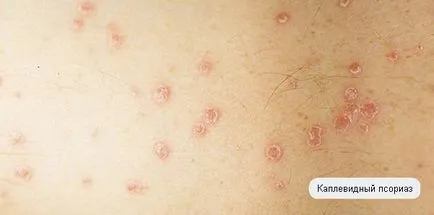 Mi az övsömör a fényképek az emberi tünetek (betegség) Mi zsindelyeink fotók emberi betegség tünetei