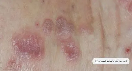 Mi zsindelyeink fotók emberi tünetek (fajta zuzmó) Mi zsindelyeink fotók emberi betegség tünetei