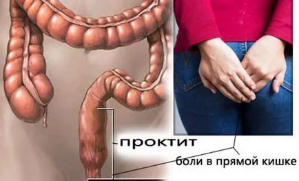 Kapszula fitomaksom plusz kezelésére papillomák (anális régió a bél) Kapszula fitomaksom Plus kezelés Szemölcsdaganatok