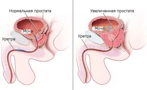Vérvizelés okok, hogy mit és hogyan kell kezelni (vizelet) Vérvizelés okok, hogy mit és hogyan kell kezelni