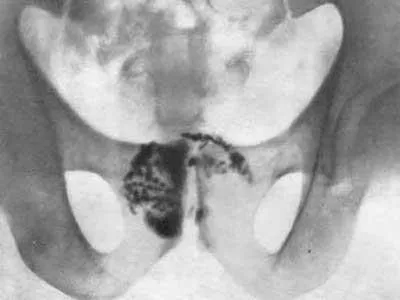 Típusú és formájú prostatitis férfiaknál, az esélye az akut és krónikus betegségek (típus) Típusú és formájú prostatitis férfiakban, akut és krónikus betegségek esélye