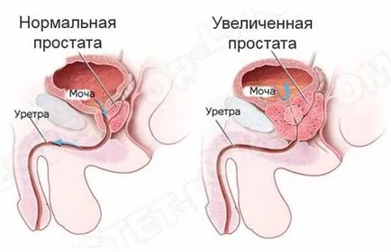 Típusai prostatitis férfiaknál, és a részletes leírását annak (amely több al) Típusú prosztatagyulladás a férfiak, és részletes leírást
