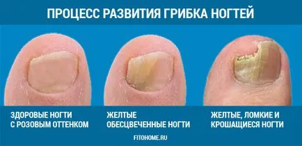Kezelése köröm gomba 2 hónap 1 h (onychomycosis) (gombák) Kezelése köröm gomba 2 hónap 1 h (onychomycosis)