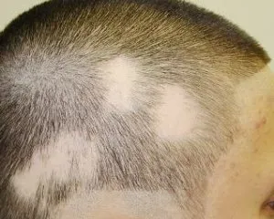 Ótvar a fotó az ember, tünetei és kezelése (ótvar emberben) Ótvar a fotó az ember, tünetei és kezelése
