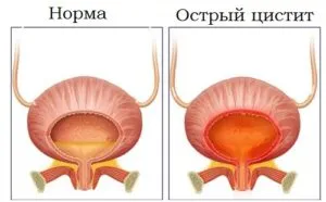 Vizelet vérrel nőknél okok