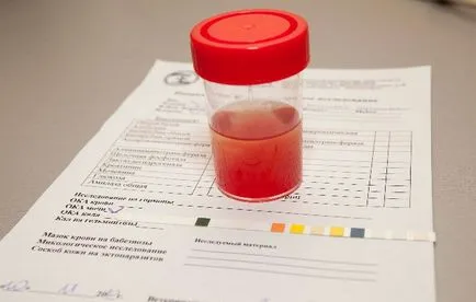 Vizelet vért az oka a nők miért, kezelés, mit kell tenni (valamilyen okból) A vizelet a vér nők az okokat, amelyek a kezelés, mit kell tenni