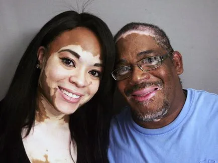 Melagenin plus (melagenina plusz) - a kezelés a vitiligo, vásárlás és a rend Moszkvában és Szentpéterváron, a költségek és Melagenin plus (melagenina plusz) - a kezelés a vitiligo, vásárlás és a rend Moszkvában és Szentpéterváron, a költségek és