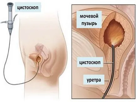 Vizelet vérrel és fájdalom vizelés közben férfiakban (fájdalom) Vizelet vérrel és fájdalom vizelés közben a férfiak