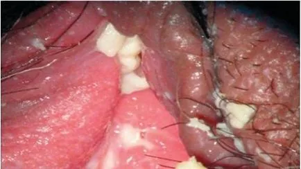 Abból, amit úgy tűnik, és úgy néz ki, mint egy rigó nők, tünetei és kezelése candidiasis (candida) Abból, amit úgy tűnik, és úgy néz ki, mint egy rigó nők, tünetei és kezelése candidiasis