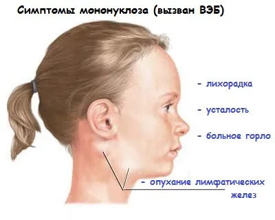 Epstein-Barr vírus - tünetei és kezelése gyermekeknél