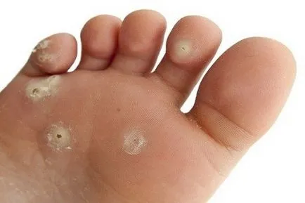 vírus papillomatosis