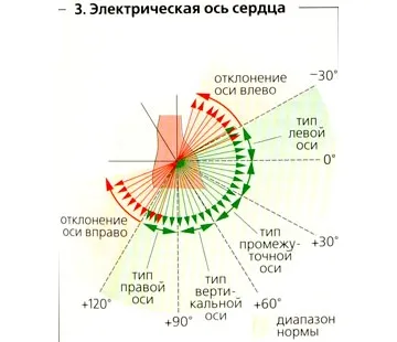 Tengely eltérés bal diagnózis a taktikát (bal tengely eltérés az EKG-n) Tengely eltérés bal diagnózis a taktikát