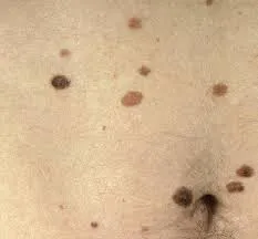 Mi okozza anyajegyek fő ok (ok) Miért kapok a fő okai a anyajegyek