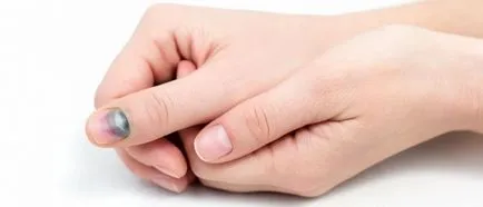 Miért megfeketedik a köröm nőknél okoz, hogyan kell gyógyítani Miért megfeketedik a köröm nőknél okoz, hogyan kell gyógyítani
