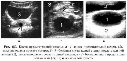 Prostatitis fejpénz diagnózis