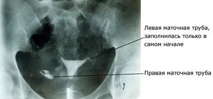 X-ray a petevezeték potenciális következmények, akárcsak