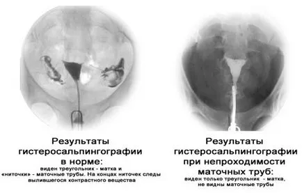 X-ray a petevezeték potenciális következmények, akárcsak