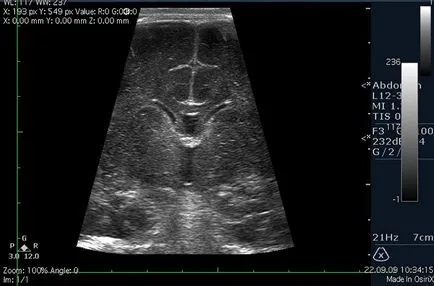 Maradék encephalopathia gyermekek - mi ez (encephalopathia) Maradék encephalopathia gyermekek - mi ez