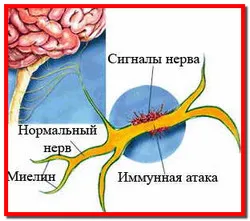 sclerosis multiplex