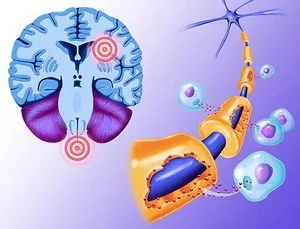 Sclerosis multiplex tünetei és kezelése