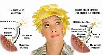 A sclerosis multiplex kezelésére népi orvosság - divatos gyönyörű