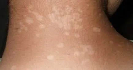 Pityriasis versicolor - fénykép emberekben, kezelés, gyógyszerek (övsömör) Pityriasis versicolor - fénykép emberekben, kezelés, gyógyszerek
