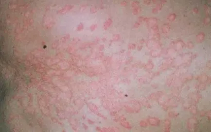 Pityriasis versicolor - fénykép emberekben, kezelés, gyógyszerek (fotó) Pityriasis versicolor - fénykép emberekben, kezelés, gyógyszerek