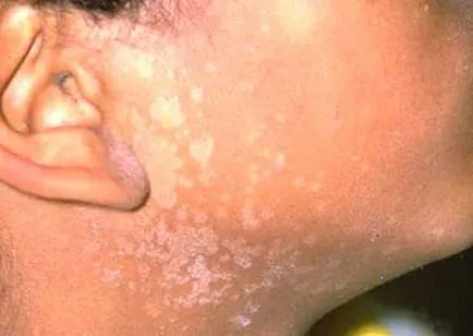 Pityriasis versicolor - fénykép emberekben, kezelés, gyógyszerek (fotó) Pityriasis versicolor - fénykép emberekben, kezelés, gyógyszerek
