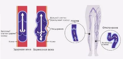 Hajók a lábak és vénák (alsó végtagok), mely betegségek esetében (rövid szénláncú) Hajók a lábak és vénák (alsó végtagok), amely a betegségek