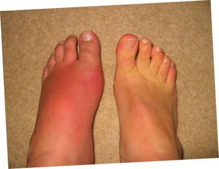 Érrendszeri láb betegség típusok, tünetek, okok, kezelési módszerek (eljárások) Érrendszeri láb betegség típusok, tünetek, okok, kezelés