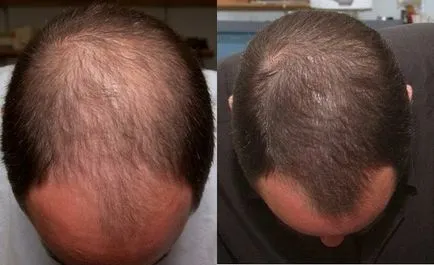 Spray generolon veszteség elleni hatásosság vélemény