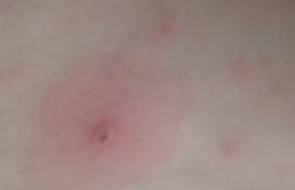 Vizes hólyagok a test fotó, esetleges betegség, kezelés, bőrbetegség (vízszerű hólyagok a szervezetben) Vizes hólyagok a test fotó, esetleges betegség, kezelés, bőrbetegségek