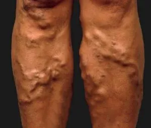 Thrombosis tünetek, okok, kezelése és megelőzése