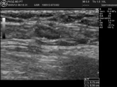 Ultrahang diagnosztika rosszindulatú elváltozások a perifériás nyirokcsomókban -