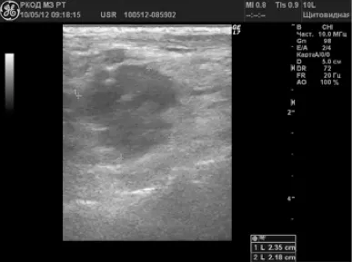 Ultrahang diagnosztika rosszindulatú elváltozások a perifériás nyirokcsomókban -