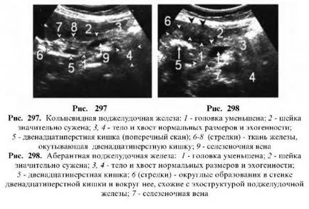 Ultrahang vizsgálat a hasnyálmirigy (pancreas) Ultrahang vizsgálat a hasnyálmirigy