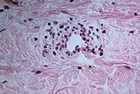 Vasculitis milyen betegség esetén a tünetek és hogyan kell kezelni (vasculitis) Vasculitis milyen betegség esetén a tünetek és hogyan kell kezelni