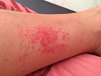 Vasculitis milyen betegség esetén a tünetek és hogyan kell kezelni Vasculitis milyen betegség esetén a tünetek és hogyan kell kezelni
