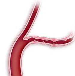 Vasculitis - mi ez a betegség, és hogyan kell kezelni azt (betegség) Vasculitis - mi ezt a betegséget hogyan kell kezelni