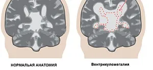 Ventriculomegalia a magzat és az újszülött gyermek, mi az, okok, kezelés következményeit (mi az) Ventriculomegalia a magzat és az újszülött gyermek, mi az, okok, kezelés, következményei