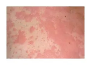 Vasculitis - Kezelés, tünetei, okai