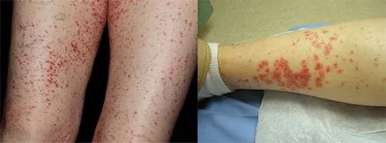 Vasculitis - mi ez a betegség, és hogyan kell kezelni azt (van egy csomó mellékhatása) Vasculitis - mi ez a betegség, és hogyan kell kezelni azt