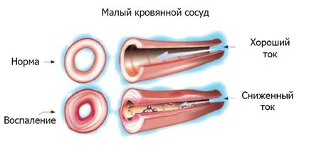 Vasculitis - mi ez a betegség, és hogyan kell kezelni azt (van egy csomó oldal) Vasculitis - mi ez a betegség, és hogyan kell kezelni azt